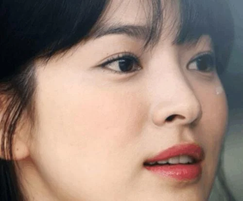 女性臉部特寫,展現細微的唇部豐盈效果。非常適合用於透明質酸豐唇文章。