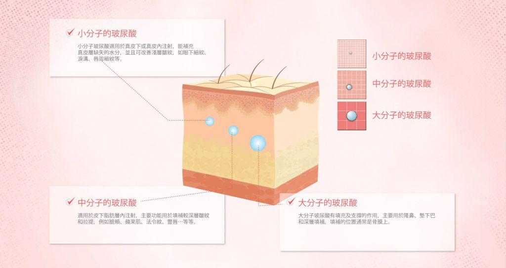 此圖顯示了不同大小的透明質酸(透明質酸)如何填充皮膚層,解決皺紋和體積損失問題。