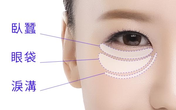 顯示注射 Teoxane 緹奧希透明質酸(透明質酸)以減少皺紋和填充皮膚的示意圖。