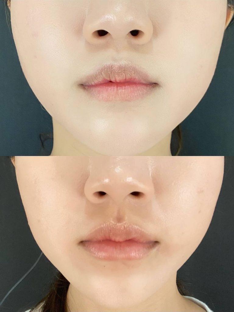 使用 Teoxane 透明質酸填充劑進行豐唇前後的比較。豐唇