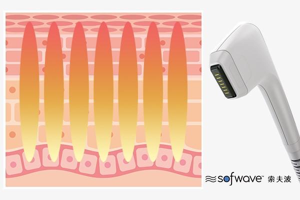 Sofwave超音波技術能夠穿透皮膚層,釋放能量,緊緻肌膚。這與Ultherapy和Thermage類似。