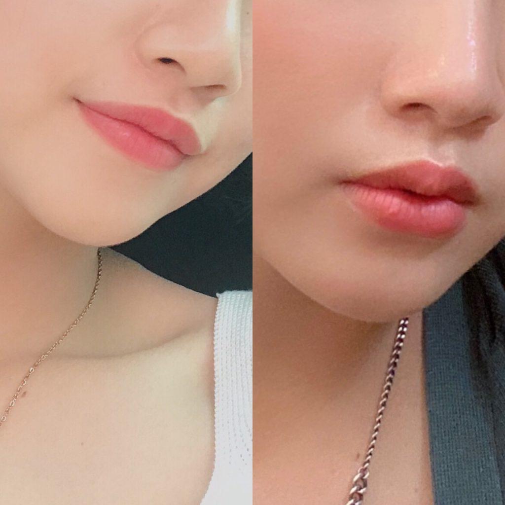 使用 Teoxane 透明質酸填充劑豐唇前後對比。豐唇效果顯著。