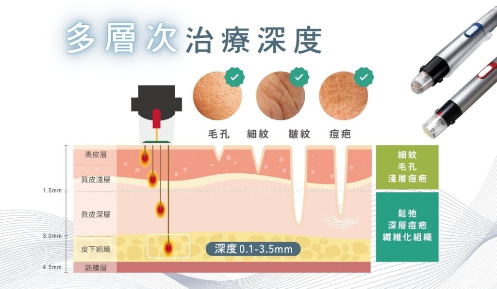 精靈電波GENIUS多層次治療深度示意圖：毛孔、細紋、皺紋、痘疤改善。深度0.1-3.5mm。