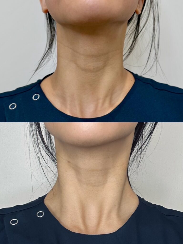 頸紋對比圖:展示頸部紋路改善前後的差異。「頸紋怎麼辦?深入解析頸紋類型與有感的4種治療方式」