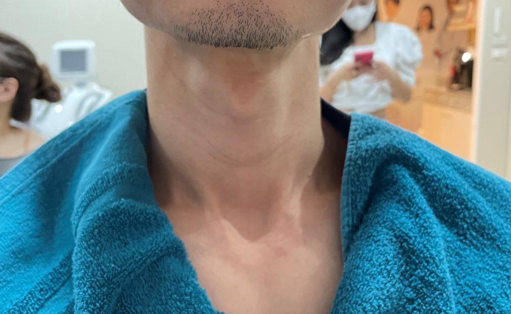 一名男子接受射頻治療後的頸部和胸部。可能為超音波刀或熱瑪吉治療的效果。