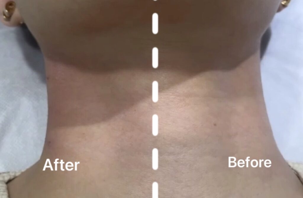 頸紋治療前後對比圖。「After」顯示頸紋改善效果。