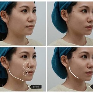 法令紋填充、輪廓線案例