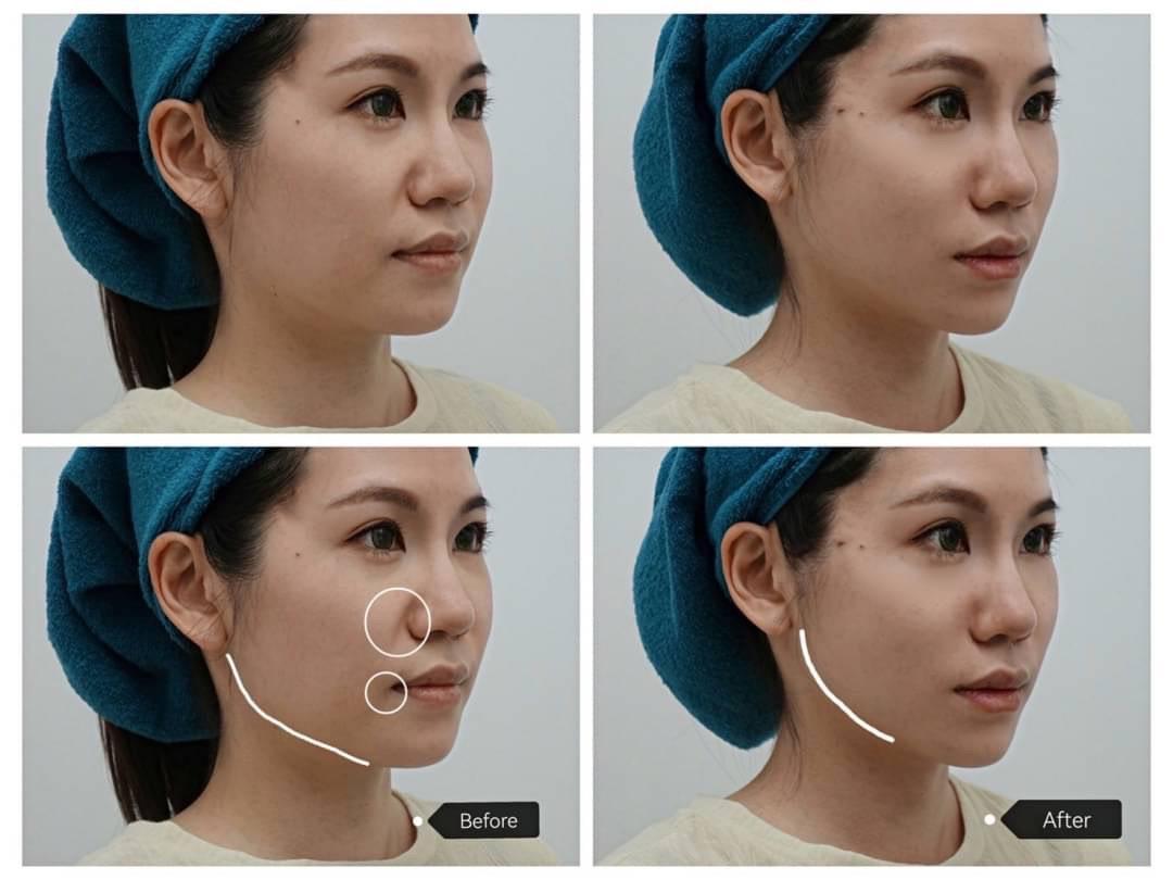 Read more about the article 法令紋填充、輪廓線案例