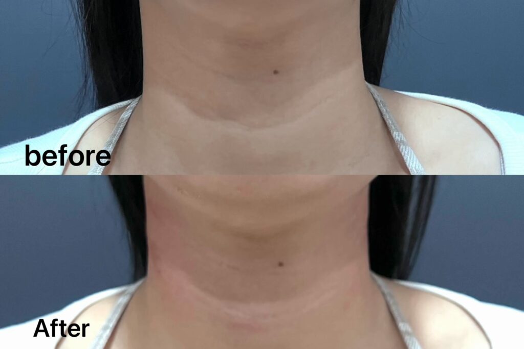 頸紋治療前後對比圖。「Before」顯示頸紋明顯,「After」顯示頸紋改善。