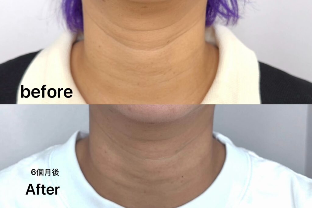 頸紋治療前後對比圖,顯示頸紋減少效果。「before」和「after」字樣。「6個月後」字樣。