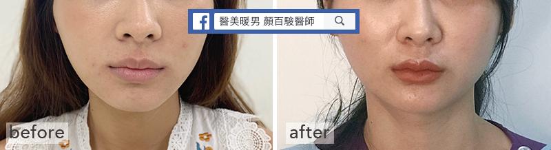 Read more about the article 玻尿酸豐唇案例｜自然飽滿、恢復期短的安全唇部填充