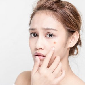 痘疤種類與治療|從紅色痘印到凹凸疤痕一次搞懂