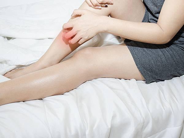 女性抓癢腿，出現冬季搔癢（冬季癢）或乾性濕疹（乾燥性濕疹）的症狀。