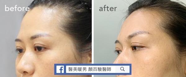 使用透明質酸填充劑填充額頭的前後照片。 豐額案例