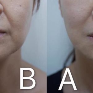 法令紋、木偶紋案例