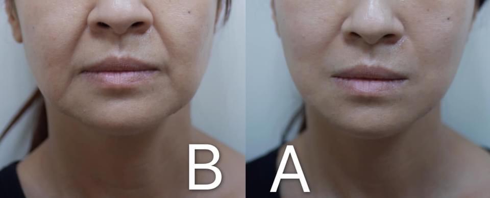 法令紋透明質酸填充劑治療前後。 醫美案例