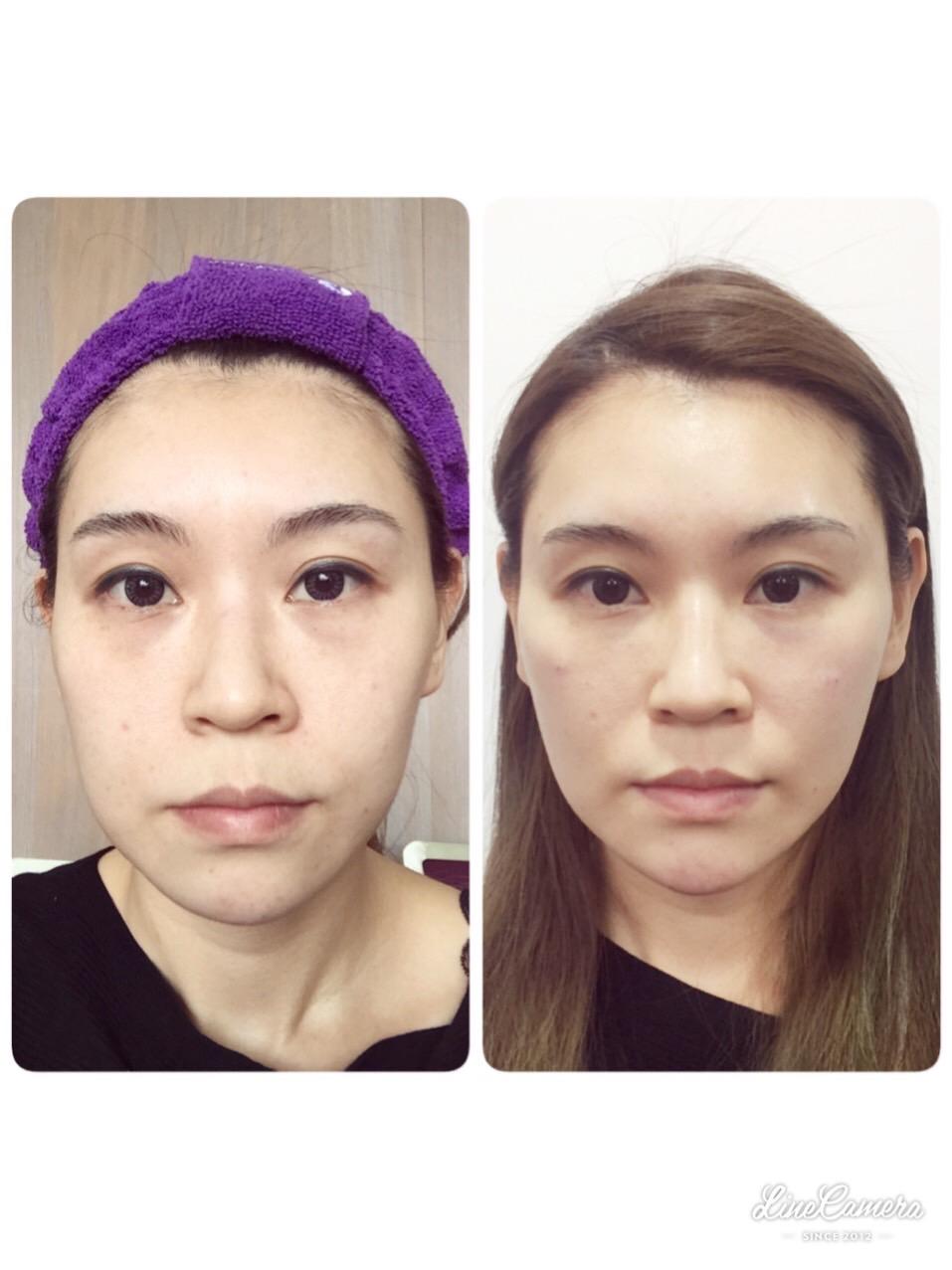 Read more about the article V臉拉提案例