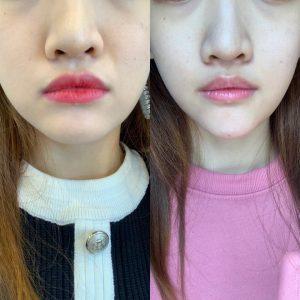 豐唇填充案例