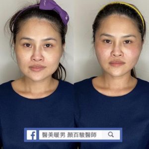 中下臉埋線案例