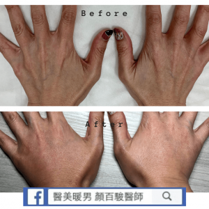 晶亮瓷/再生針｜雞爪手案例