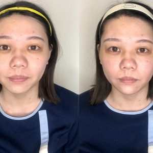 晶亮瓷骨架支撐案例