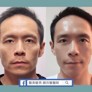 舒顏萃(童顏針)案例