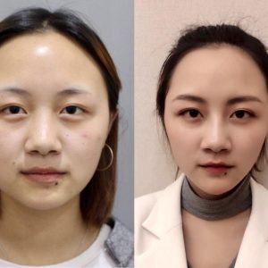 複合式微整案例