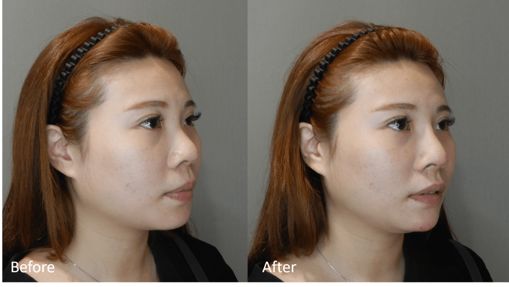 使用透明質酸填充劑進行鼻整形手術前後的剖面圖。 山根填充和鼻子填充結果。