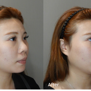 鼻子BA側面案例-2