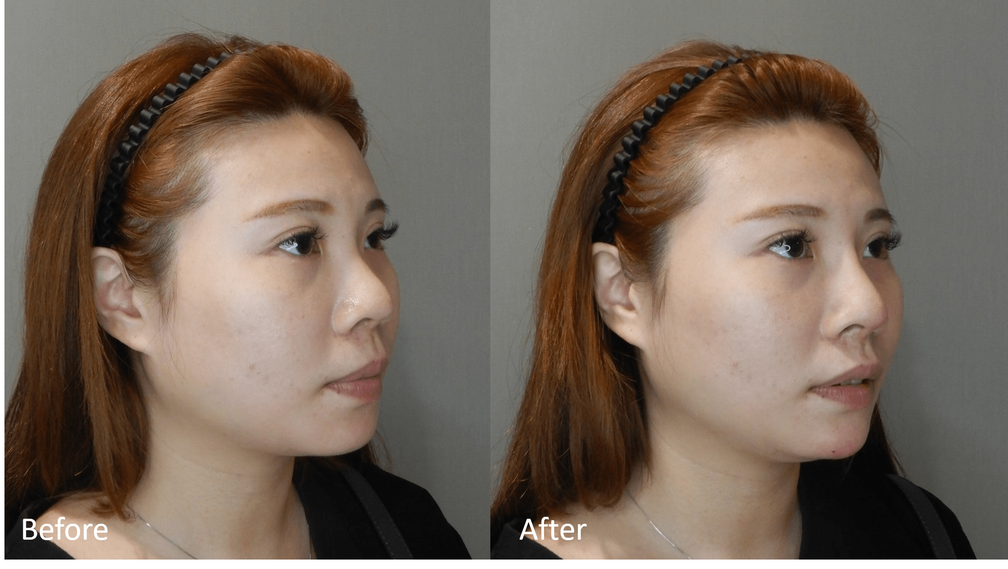 Read more about the article 鼻子BA側面案例-2