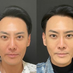 輪廓線埋線拉提案例