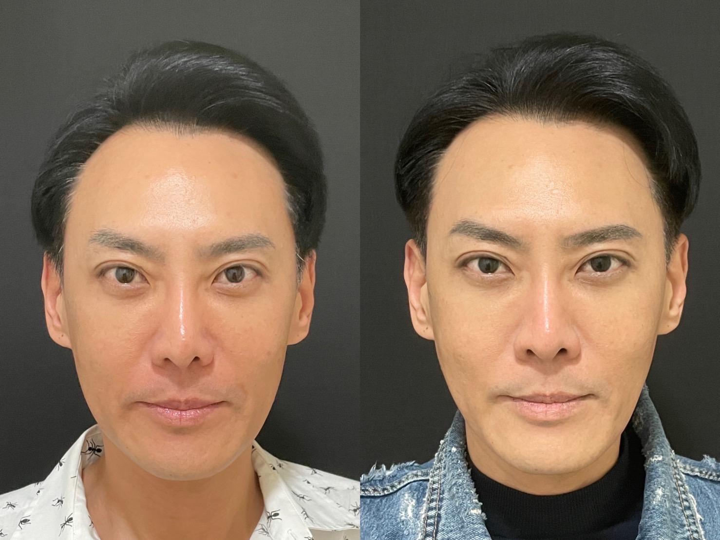 Read more about the article 輪廓線埋線拉提案例