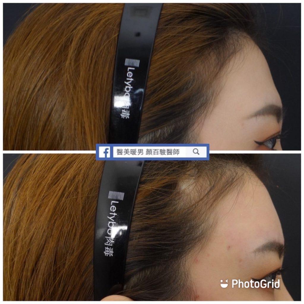 使用透明質酸填充劑填充額頭前後。 豐額案例