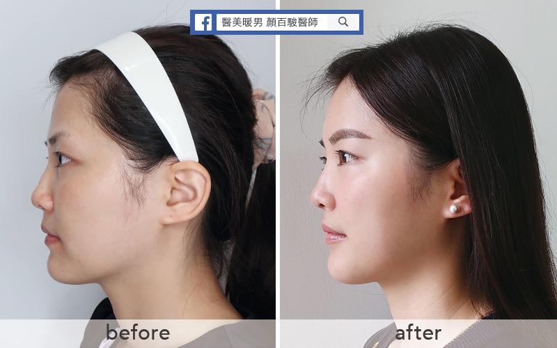 豐額填充前後對比：側面圖顯示前額豐滿度有改善。