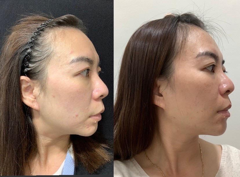 下巴填充術前後效果。 玻尿酸下巴填充案例