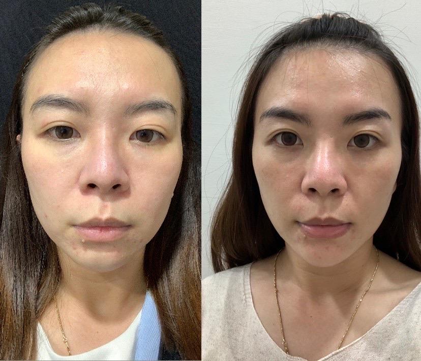 Read more about the article 下巴填充案例