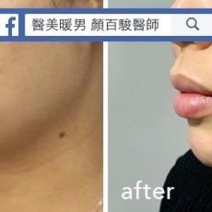 下巴填充案例-2