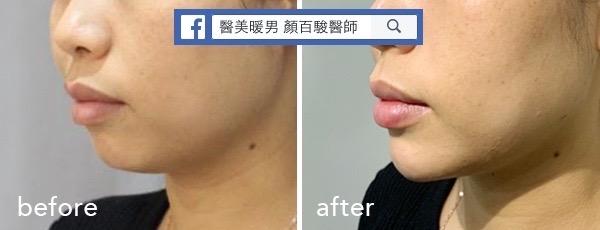 Read more about the article 下巴填充案例-2
