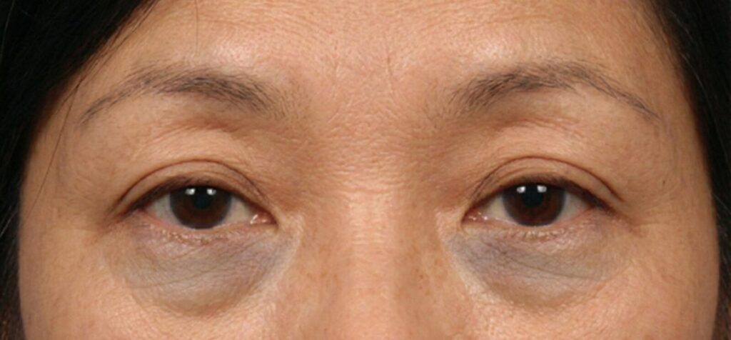 眼睛下方有黑眼圈的女性特寫。顯示黑眼圈和眼睛周圍的細紋。