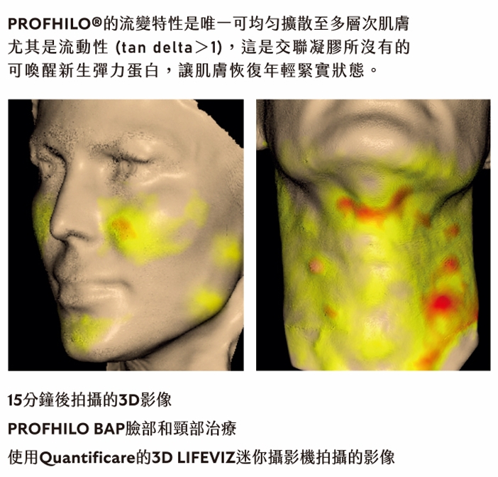 Profhilo 療程前後:3D 皮膚掃描顯示皮膚紋理和體積已改善。