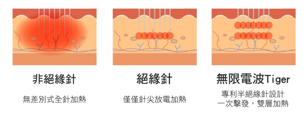 三種射頻療法的比較