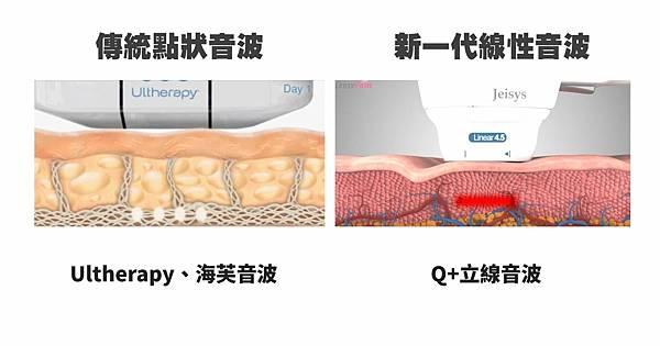 Ultherapy(點)和 Q+(線性)超音波緊膚技術的比較。 Q+音波、海芙音波、音波拉提。