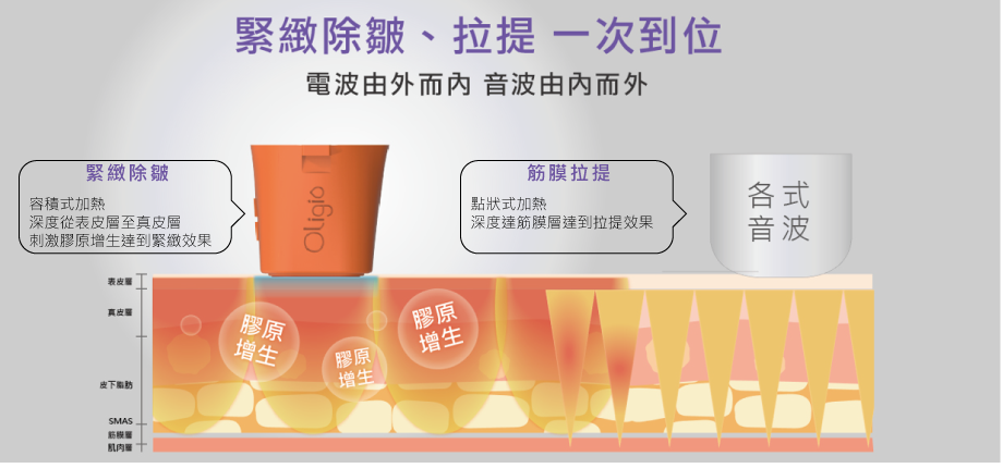 此圖顯示超音波和射頻治療如何針對膠原蛋白和 SMAS 層提升和緊緻肌膚。 鳳凰電波和音波拉提效果圖解。