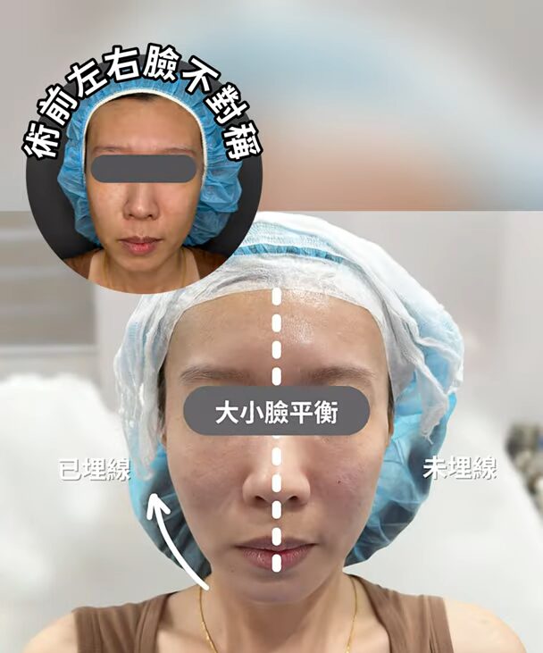 埋線拉提前後對比：臉部大小不對稱，術後大小平衡。