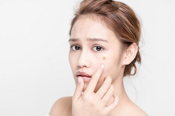 一位女士摸著臉頰上的粉刺,擔心痤瘡疤痕和變色。