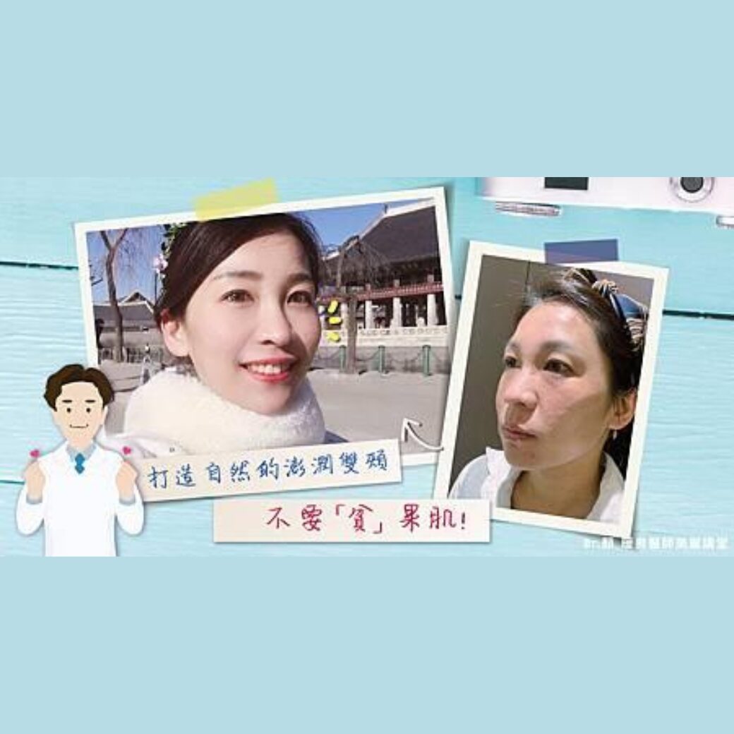 Read more about the article 明明睡很飽卻一臉倦容？醫師揭密蘋果肌凹陷3大成因與填補急救術