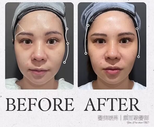 臉部微整前後對比圖:術前臉型較寬,術後臉型更緊緻。暖男醫師分享的全臉醫美設計範例。