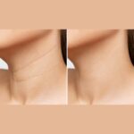 頸紋治療前後對比圖,顯示脖紋明顯改善。