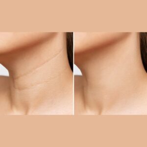 頸紋怎麼辦?深入解析頸紋類型與有感的4種治療方式