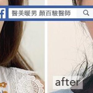 玻尿酸豐唇案例｜自然飽滿、恢復期短的安全唇部填充